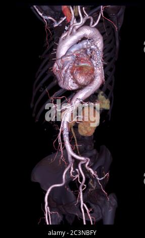 CTA Abdominal Aorta 3D-Rendering-Bild auf transparenten Skelett . Stockfoto