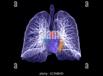 CT Brust oder Lunge 3D-Rendering-Bild mit 3D-Herz für die Diagnose TB, Tuberkulose und covid-19 . Stockfoto