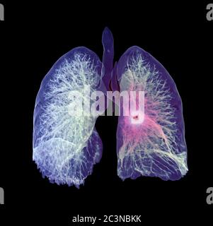 CT Brust oder Lunge 3D-Rendering-Bild für die Diagnose TB, Tuberkulose und covid-19 . Stockfoto