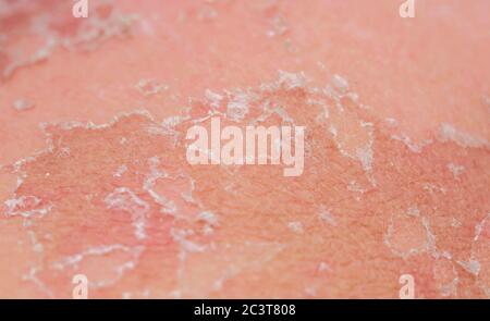 Textur der gereizten Haut mit Rissen von abgestorbenen Zellen und Rötungen nach Sonnenbrand und Allergien auf den menschlichen Körper Stockfoto