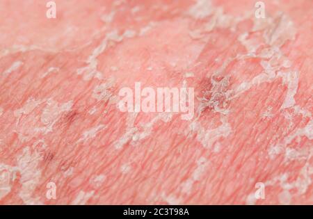 Textur von gereizter geröteter Haut mit abblätternden Schuppen von toten alten Zellen nach Sonnenbrand und Allergien auf den Menschen Stockfoto