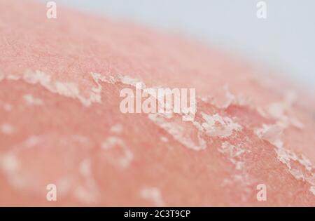 Textur von gereizter geröteter Haut mit schuppenden Schuppen und Rissen von Sonnenbrand und Allergien auf den menschlichen Körper Stockfoto