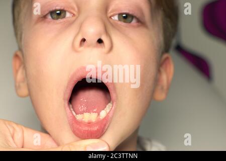 Kind zeigt fehlende Zähne, er hat zwei Kalbszähne verloren. Nahaufnahme Porträt des blonden kaukasischen Jungen lächeln ohne zwei Vorderzähne. Stockfoto