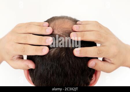 Kahlheit, Mann über Haarausfall. Männliche Kopf mit einem kahlen auf weißem Hintergrund Stockfoto