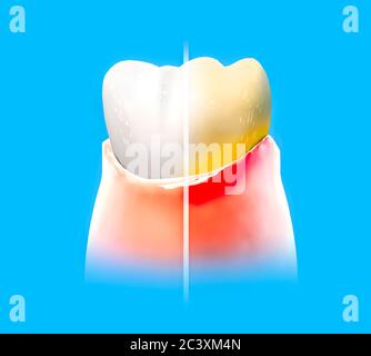 Zahn, Wunde Zahnfleisch, Rötung, Zahnmedizin, Zahnreinigung, Mundhygiene. Mit Zahnpasta, um den Zahn vor Plaque Bildung zu schützen, 3d-Rendern Stockfoto
