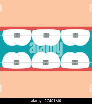 Vektorzähne Klammern flache Abbildung Stock Vektor