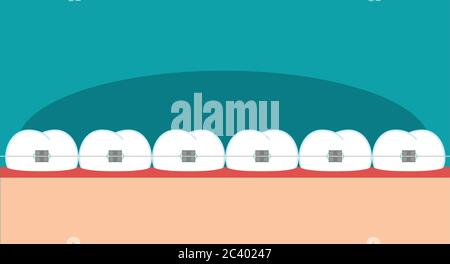 Vektorzähne Klammern flache Abbildung Stock Vektor