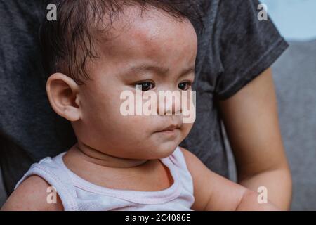 Portrait von asiatischen Baby mit Hautausschläge von Allergien oder Reizungen und juckende Stockfoto