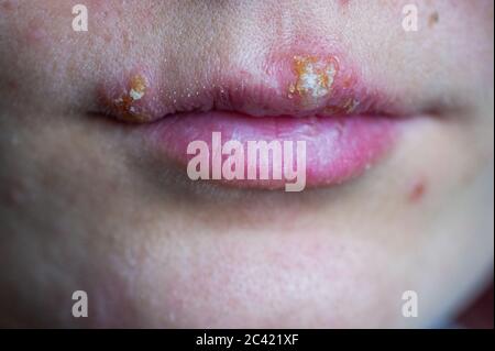 Herpes-Krankheit auf den Lippen eines jungen Mädchens. Wunden von Herpes auf den Lippen einer Person. Herpes foci. Stockfoto