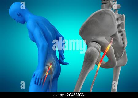 Geknickte menschlichen Ischiasnerv, anatomische Vision. 3d-Illustration. Stockfoto