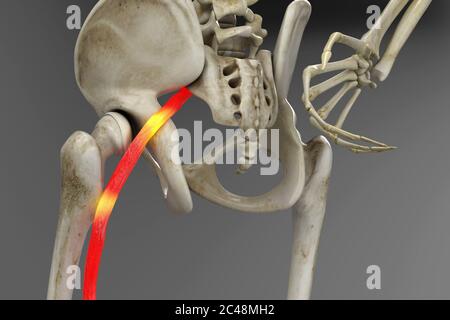 Geknickte menschlichen Ischiasnerv, anatomische Vision. 3d-Illustration. Stockfoto