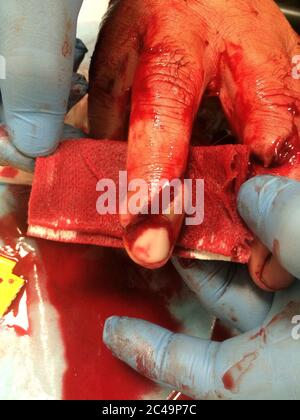 Offene Fraktur, Risswunden zu den Fingern.Blutige Finger und Hände. Verletzungen durch Propellor-Hände, die dringend im Krankenhaus behandelt werden müssen. Stockfoto