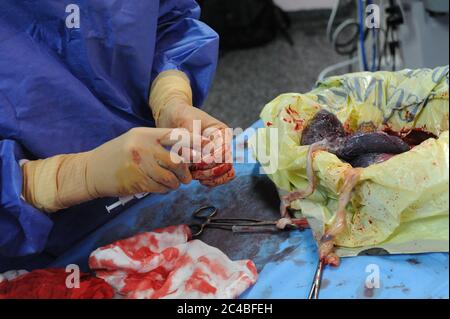 Bericht im Entbindungskrankenhaus des Abbeville Krankenhauses. Kaiserschnitt Geburt einer schwangeren Frau mit Zwillingen. Geplante Intervention. Präsenz im Stockfoto