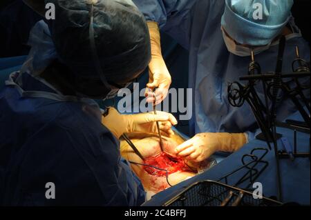 Bericht im Entbindungskrankenhaus des Abbeville Krankenhauses. Kaiserschnitt Geburt einer schwangeren Frau mit Zwillingen. Geplante Intervention. Präsenz im Stockfoto