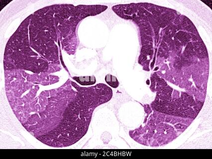 Lungenfibrose (Läsion der Lunge, gekennzeichnet durch das Vorhandensein von überschüssigem faserigem Bindegewebe). Viele Pathologien sind beteiligt, einschließlich c Stockfoto