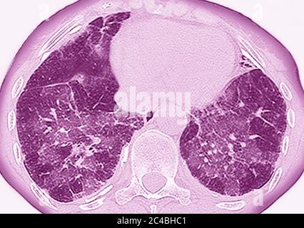 Lungenfibrose (Läsion der Lunge, gekennzeichnet durch das Vorhandensein von überschüssigem faserigem Bindegewebe). Viele Pathologien sind beteiligt, einschließlich c Stockfoto