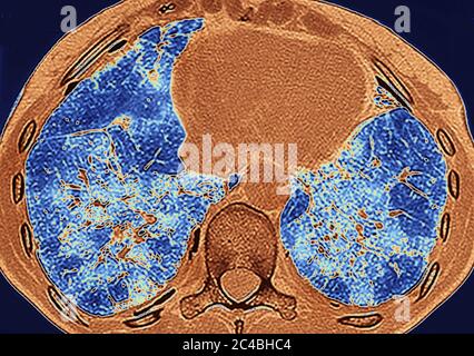 Lungenfibrose (Läsion der Lunge, gekennzeichnet durch das Vorhandensein von überschüssigem faserigem Bindegewebe). Viele Pathologien sind beteiligt, einschließlich c Stockfoto