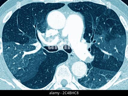 Lungenfibrose (Läsion der Lunge, gekennzeichnet durch das Vorhandensein von überschüssigem faserigem Bindegewebe). Viele Pathologien sind beteiligt, einschließlich c Stockfoto