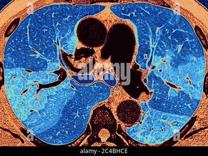 Lungenfibrose (Läsion der Lunge, gekennzeichnet durch das Vorhandensein von überschüssigem faserigem Bindegewebe). Viele Pathologien sind beteiligt, einschließlich c Stockfoto