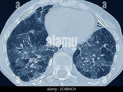 Lungenfibrose (Läsion der Lunge, gekennzeichnet durch das Vorhandensein von überschüssigem faserigem Bindegewebe). Viele Pathologien sind beteiligt, einschließlich c Stockfoto