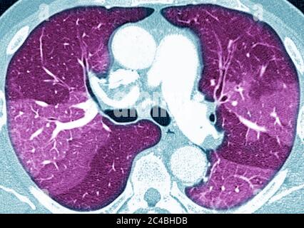 Lungenfibrose (Läsion der Lunge, gekennzeichnet durch das Vorhandensein von überschüssigem faserigem Bindegewebe). Viele Pathologien sind beteiligt, einschließlich c Stockfoto