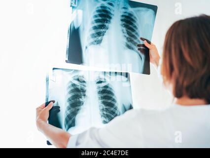 Ärztin beim Vergleich der Röntgenfilm-Lungen von zwei Patienten in der Radiologie im Krankenhaus.Lungenerkrankungen oder Covid-19 Scan Lunge Röntgenstrahl dye Stockfoto