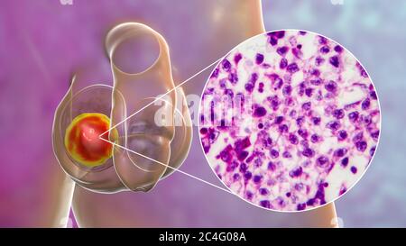 Hodenkrebs, ein maligner Spermatozytenvorfall, Computerdarstellung und leichte Mikrograph. Ein Seminom ist ein bösartiger Tumor (Krebs) des Hodens (Hoden). Obwohl es sich um eine seltene Krebserkrankung handelt, ist sie die häufigste Krebserkrankung bei 15 bis 35-jährigen Männern. Es entsteht aus abnormen Keimzellen (Vorläufer zu Spermien) in den seminiferösen Tubuli. Die chirurgische Entfernung des betroffenen Hodens (Orchidektomie) wird bei Bedarf durch Strahlentherapie und Chemotherapie begleitet. Stockfoto