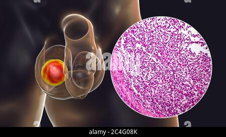 Hodenkrebs, ein maligner Spermatozytenvorfall, Computerdarstellung und leichte Mikrograph. Ein Seminom ist ein bösartiger Tumor (Krebs) des Hodens (Hoden). Obwohl es sich um eine seltene Krebserkrankung handelt, ist sie die häufigste Krebserkrankung bei 15 bis 35-jährigen Männern. Es entsteht aus abnormen Keimzellen (Vorläufer zu Spermien) in den seminiferösen Tubuli. Die chirurgische Entfernung des betroffenen Hodens (Orchidektomie) wird bei Bedarf durch Strahlentherapie und Chemotherapie begleitet. Stockfoto