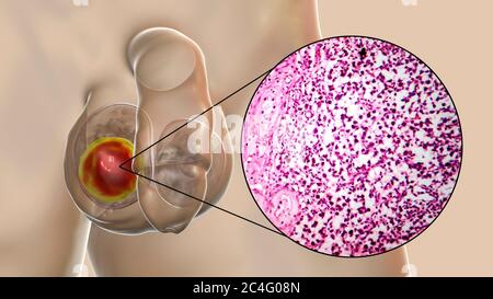Hodenkrebs, ein maligner Spermatozytenvorfall, Computerdarstellung und leichte Mikrograph. Ein Seminom ist ein bösartiger Tumor (Krebs) des Hodens (Hoden). Obwohl es sich um eine seltene Krebserkrankung handelt, ist sie die häufigste Krebserkrankung bei 15 bis 35-jährigen Männern. Es entsteht aus abnormen Keimzellen (Vorläufer zu Spermien) in den seminiferösen Tubuli. Die chirurgische Entfernung des betroffenen Hodens (Orchidektomie) wird bei Bedarf durch Strahlentherapie und Chemotherapie begleitet. Stockfoto