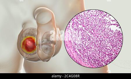 Hodenkrebs, ein maligner Spermatozytenvorfall, Computerdarstellung und leichte Mikrograph. Ein Seminom ist ein bösartiger Tumor (Krebs) des Hodens (Hoden). Obwohl es sich um eine seltene Krebserkrankung handelt, ist sie die häufigste Krebserkrankung bei 15 bis 35-jährigen Männern. Es entsteht aus abnormen Keimzellen (Vorläufer zu Spermien) in den seminiferösen Tubuli. Die chirurgische Entfernung des betroffenen Hodens (Orchidektomie) wird bei Bedarf durch Strahlentherapie und Chemotherapie begleitet. Stockfoto