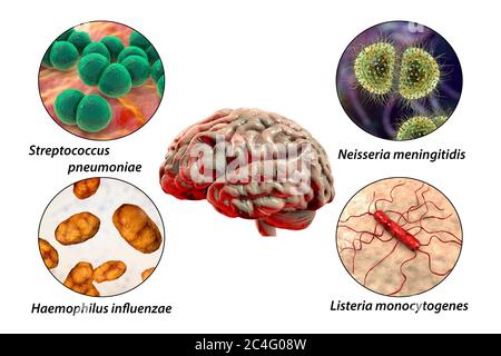 Ursachen der bakteriellen Meningitis, Computer-Illustration. Neisseria meningitidis, Streptococcus pneumoniae, Haemophilus influenzae und Listeria monocytogenes Bakterien, die wichtigsten Erreger der bakteriellen Meningitis. Beschriftetes Bild. Stockfoto