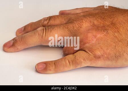 Mans linke Hand mit entferntem dritten Finger Stockfoto