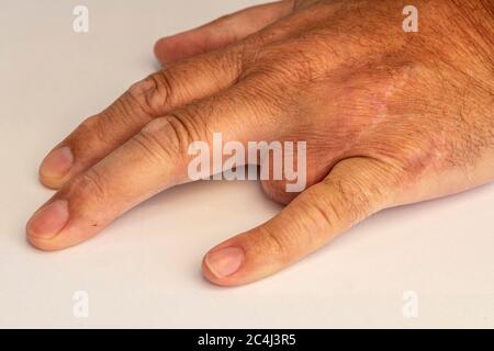 Mans linke Hand mit entferntem dritten Finger Stockfoto