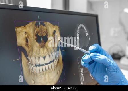Zahnärztliche Beratung in der Klinik. Zahnarzt zeigt 3D-Tomographie Bild auf dem Bildschirm Stockfoto