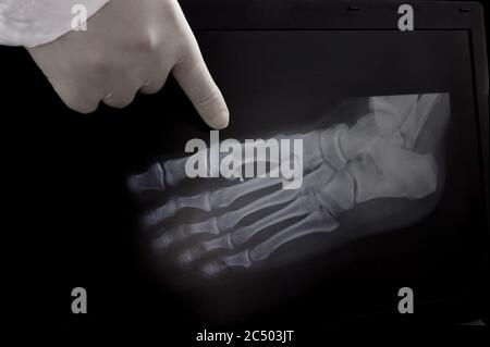 Röntgenbild des Fußes. Der Arzt zeigt mit dem Finger auf die Wucherungen am Knochen. Stockfoto
