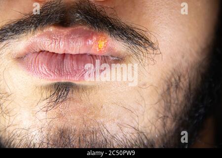 Nahaufnahme Detail kaukasischen bärtigen Mann, der leidet Herpes-simplex-Virus auf den Lippen. Stockfoto