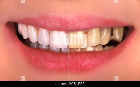 Perfektes Lächeln vor und nach dem Bleichen Verfahren Bleaching von jungen glücklich lächelnden Frau. Zahnwiederherstellung Behandlung Klinik Patient.Demonstration Stockfoto