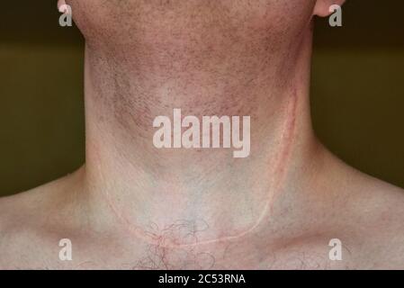 Narbe Am Hals Stockfotografie Alamy