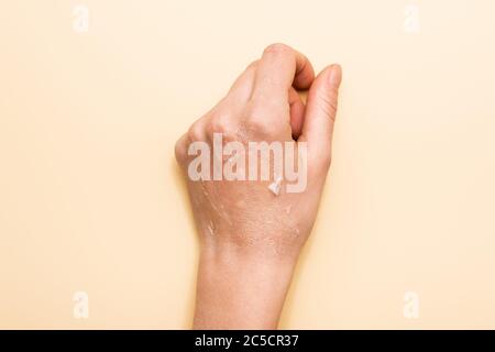 Beschnittene Ansicht der weiblichen Hand mit dehydrierter, peelierter Haut auf Beige Stockfoto