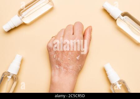 Beschnittene Ansicht der weiblichen Hand mit trockener, exfoliierter Haut in der Nähe von Sprühflaschen mit Antiseptikum auf Beige Stockfoto