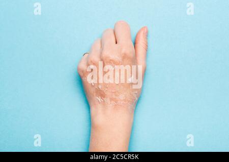 Beschnittene Ansicht der weiblichen Hand mit trockener, peelierter Haut auf blau Stockfoto