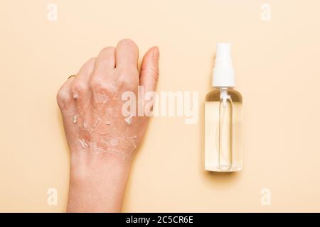 Beschnittene Ansicht der weiblichen Hand mit dehydrierter, exfoliierter Haut in der Nähe von Desinfektionsmittel auf Beige Stockfoto