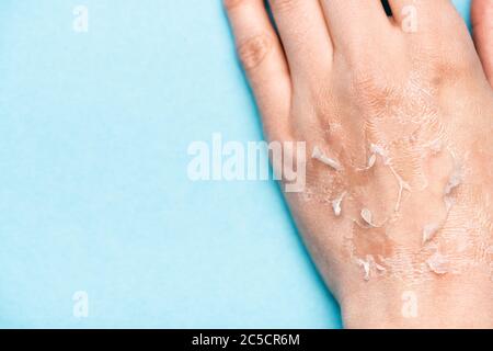 Teilansicht der weiblichen Hand mit dehydrierter, exfoliierter Haut auf Blau Stockfoto