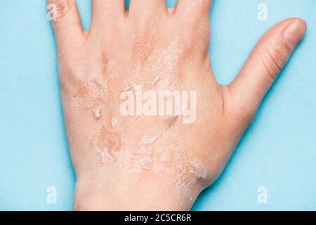Teilansicht der weiblichen Hand mit trockener, peelierter Haut auf blau Stockfoto