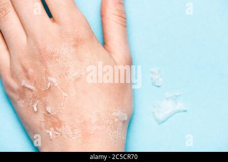 Beschnittene Ansicht der weiblichen Hand mit abgestorbener, ausgefoliierter Haut auf blau Stockfoto