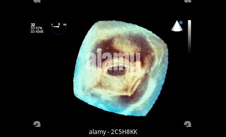 3D-Bild des Herzens während der transösophagealen Ultraschall des Herzens. Stockfoto