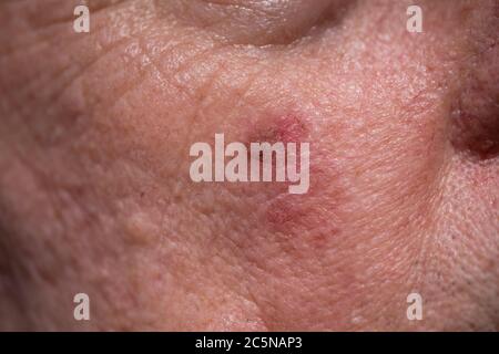 Rote Krustenläsionen aktinischer Keratose oder Sonnenflecken auf sonnengeschädigter Haut auf der Wange unter dem rechten Auge eines Mannes Stockfoto