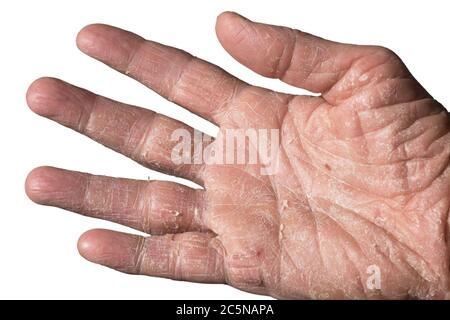 Ekzem mit Rötungen, Schwellungen, Beulen und Flocken an Hand und Fingern eines Mannes, verursacht durch Sonne, Atopie oder Kontaktallergene. Isoliert auf Weiß Stockfoto