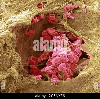 Blutgefäß der Haut. Farbiger Rasterelektronenmikrograph (SEM) eines Blutgefäßes (Arteriole) in der Dermis der Haut. Im Blutgefäß befinden sich rote Blutkörperchen (Erythrozyten, rot), die Sauerstoff um den Körper transportieren. Einige dieser roten Blutkörperchen sind zenkreniert. Das Blutgefäß ist von Bindegewebe umgeben, das der Haut ihren Ton und ihre Elastizität verleiht. Vergrößerung: 1000 bei 10 Zentimeter Breite. Stockfoto
