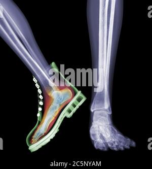 Skelettfüße mit einem Fuß im Stiefel, farbiges Röntgen. Stockfoto